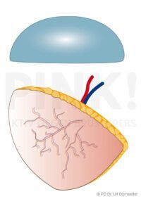 Implantat und Eigengewebe