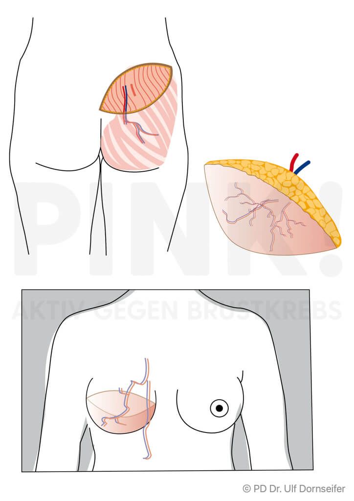 SGAP Lappen