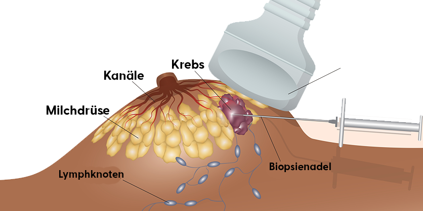 Stanzbiopsie