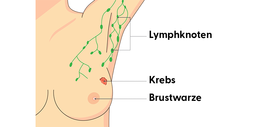Lymphknoten